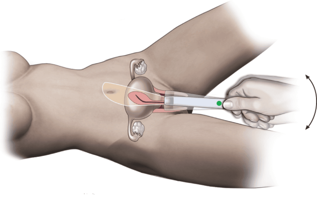Siêu âm đầu dò âm đạo