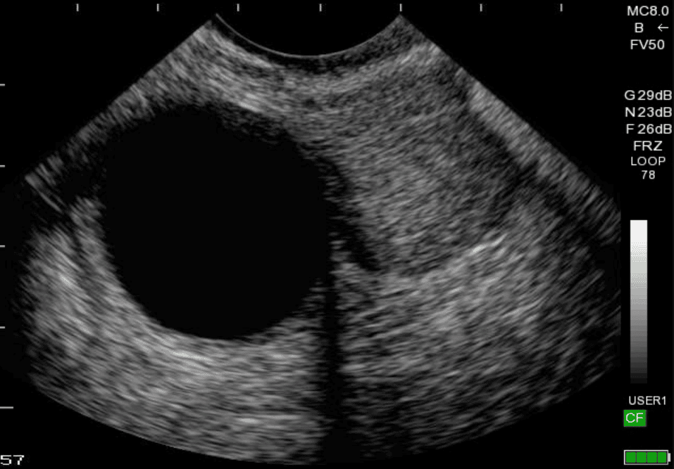 U nang buồng trứng